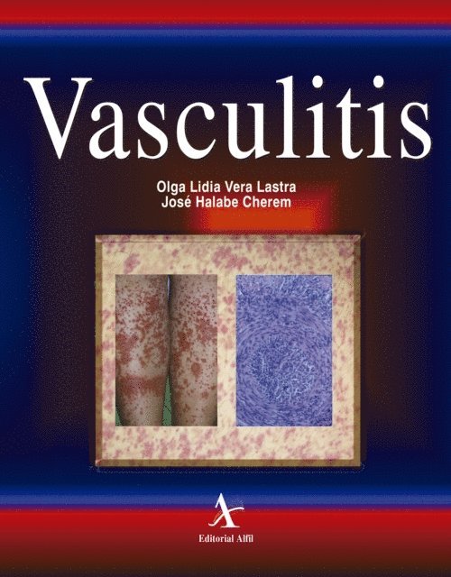 Jose Halabe Cherem, Olga Lidia Vera Lastra - Vasculitis, E-bok