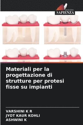 Varshini K R, Jyot Kaur Kohli, Ashwini K - Materiali per la progettazione di strutture per protesi fisse su impianti, Häftad. Tillgänglighet: Lägg i varukorg