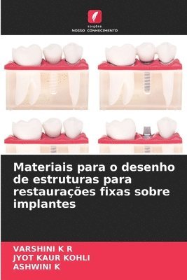 Varshini K R, Jyot Kaur Kohli, Ashwini K - Materiais para o desenho de estruturas para restaurações fixas sobre implantes, Häftad. Tillgänglighet: Lägg i varukorg