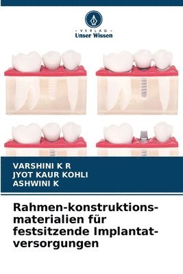 Varshini K R, Jyot Kaur Kohli, Ashwini K - Rahmen-konstruktions-materialien für festsitzende Implantat-versorgungen, Häftad. Tillgänglighet: Lägg i varukorg