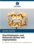 Maxillektomie und Rekonstruktion mit Implantaten