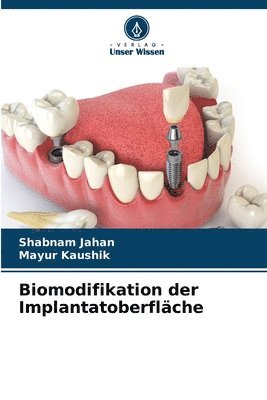 Shabnam Jahan, Mayur Kaushik - Biomodifikation der Implantatoberfläche, Häftad. Tillgänglighet: Lägg i varukorg