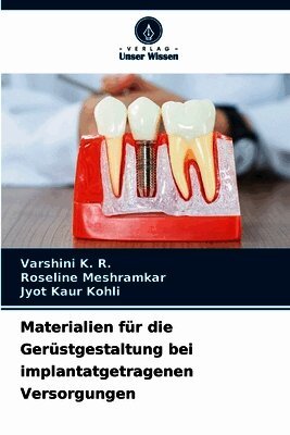 Varshini K R, Roseline Meshramkar, Jyot Kaur Kohli - Materialien für die Gerüstgestaltung bei implantatgetragenen Versorgungen, Häftad. Tillgänglighet: Lägg i varukorg