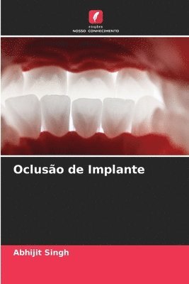 Abhijit Singh - Oclusão de Implante, Häftad. Tillgänglighet: Lägg i varukorg