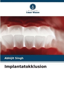Abhijit Singh - Implantatokklusion, Häftad. Tillgänglighet: Lägg i varukorg
