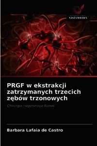 PRGF w ekstrakcji zatrzymanych trzecich z?b�w trzonowych