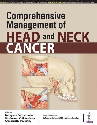 Narayana Subramaniam, Sivakumar Vidhyadharan, Samskruthi P Murthy - Comprehensive Management of Head and Neck Cancer, Häftad