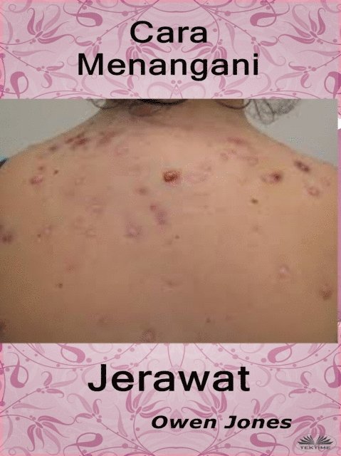Owen Jones - Cara Menangani Jerawat, E-bok