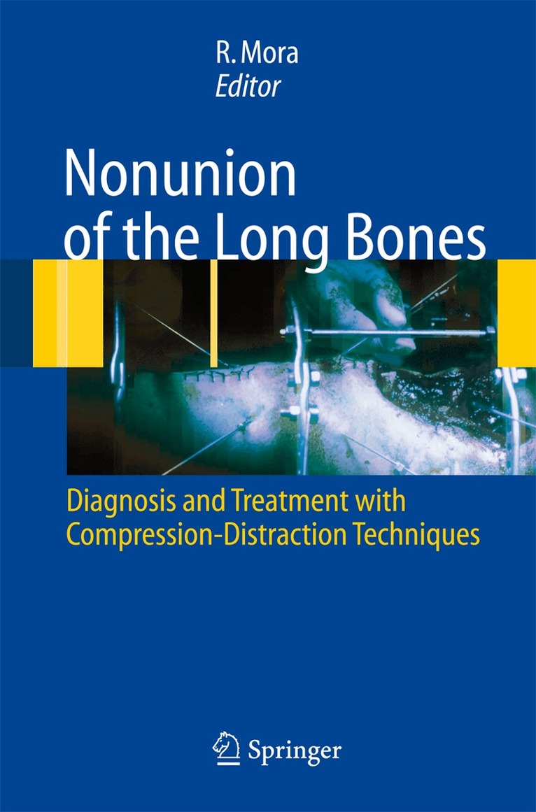 Redento Mora - Nonunion of the Long Bones, Inbunden. Tillgänglighet: Lägg i varukorg