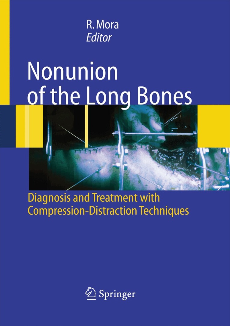Redento Mora - Nonunion of the Long Bones, Häftad. Tillgänglighet: Lägg i varukorg