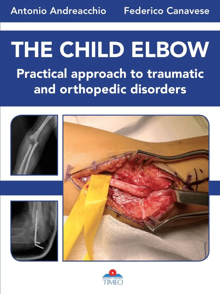 Florence Muller, Thomas Wirth, Christina Steiger, Darko Anticevic, Deborah Eastwood, Hakan Omeroglu, Renaud Rossillon, Maurizio De Pellegrin, Antonio Andreacchio, Federico Canavese - Child Elbow, Inbunden. Tillgänglighet: Tillfälligt slut