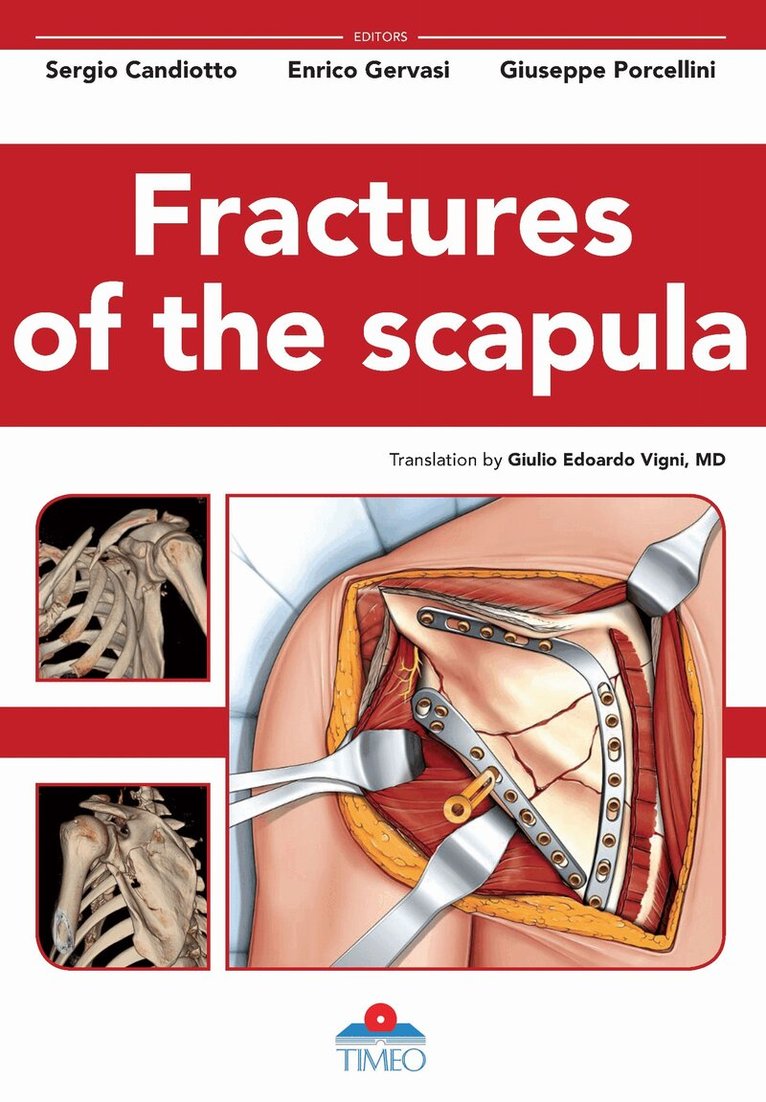 Sergio Candiotto, Enrico Gervasi, Giuseppe Porcellini - Fractures of the Scapula, Inbunden. Tillgänglighet: Tillfälligt slut