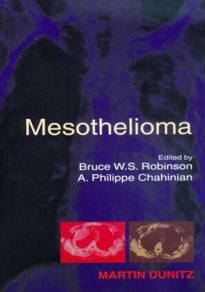 Bruce W S Robinson, A Philippe Chahinian - Mesothelioma, Inbunden. Tillgänglighet: Tillfälligt slut