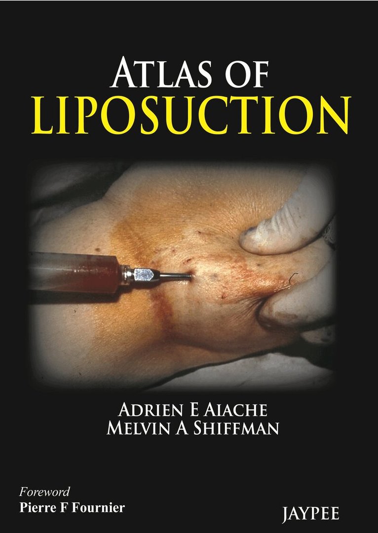 Adrien E Aiache, Melvin A Shiffman - Atlas of Liposuction, Inbunden