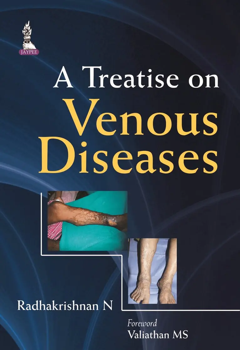 Treatise on Venous Diseases