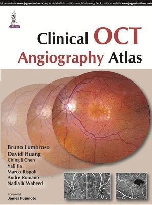 Bruno Lumbroso, David Huang - Clinical OCT Angiography Atlas, Inbunden. Tillgänglighet: Lägg i varukorg