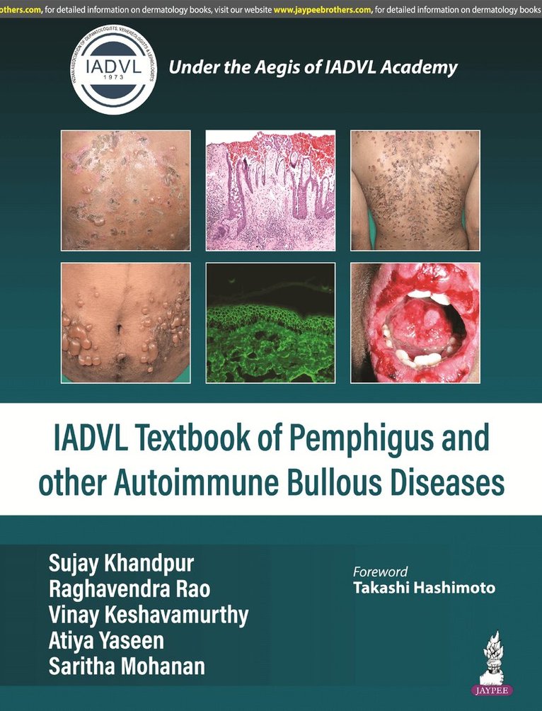 Sujay Khandpur, Raghavendra Rao, Atiya Yaseen, Saritha Mohanan - Textbook of Pemphigus and other Autoimmune Bullous Diseases, Inbunden