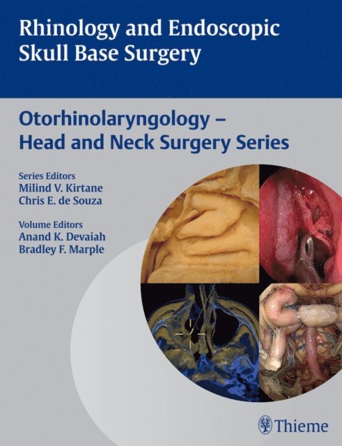 Bradley F. Marple, Anand K. Devaiah - Rhinology and Endoscopic Skull Base Surgery, E-bok
