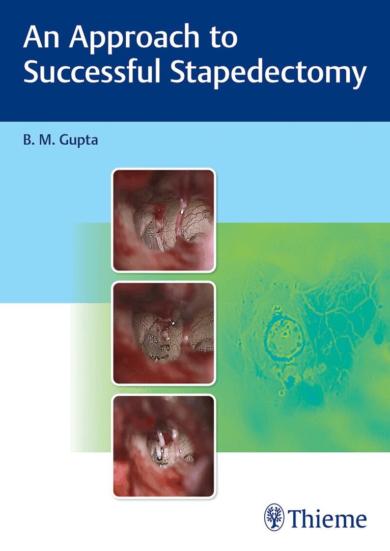 B Gupta - Approach to Successful Stapedectomy, Inbunden