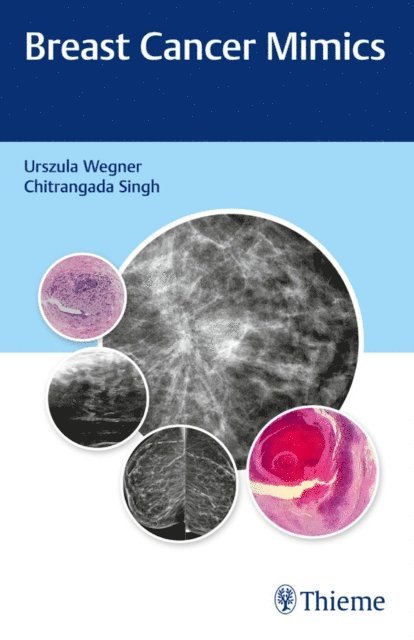 Chitrangada Singh, Urszula Wegner - Breast Cancer Mimics, E-bok