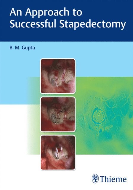 B. M. Gupta - Approach to Successful Stapedectomy, E-bok