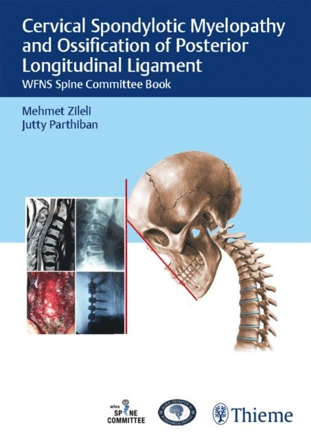 Jutty Parthiban, Mehmet Zileli - Cervical Spondylotic Myelopathy and Ossification of Posterior Longitudinal Ligament, E-bok