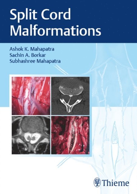 Subhashree Mahapatra, Sachin A. Borkar, Ashok K. Mahapatra - Split Cord Malformations, E-bok. Tillgänglighet: Lägg i varukorg