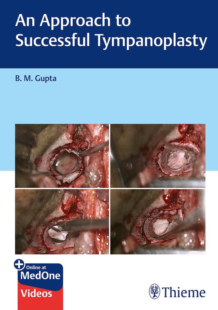 B Gupta - Approach to Successful Tympanoplasty, Övrigt