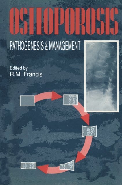 R.M. Francis - Osteoporosis, E-bok