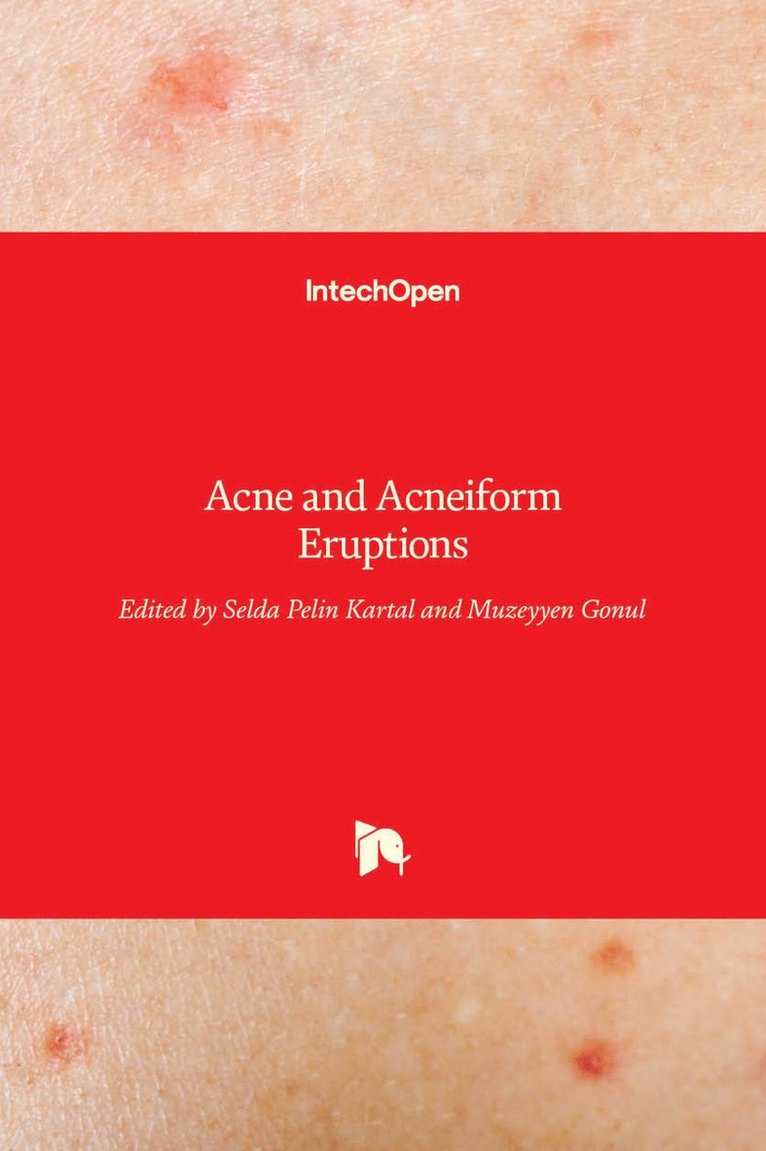Selda Pelin Kartal, Muzeyyen Gonul - Acne and Acneiform Eruptions, Inbunden. Tillgänglighet: Lägg i varukorg