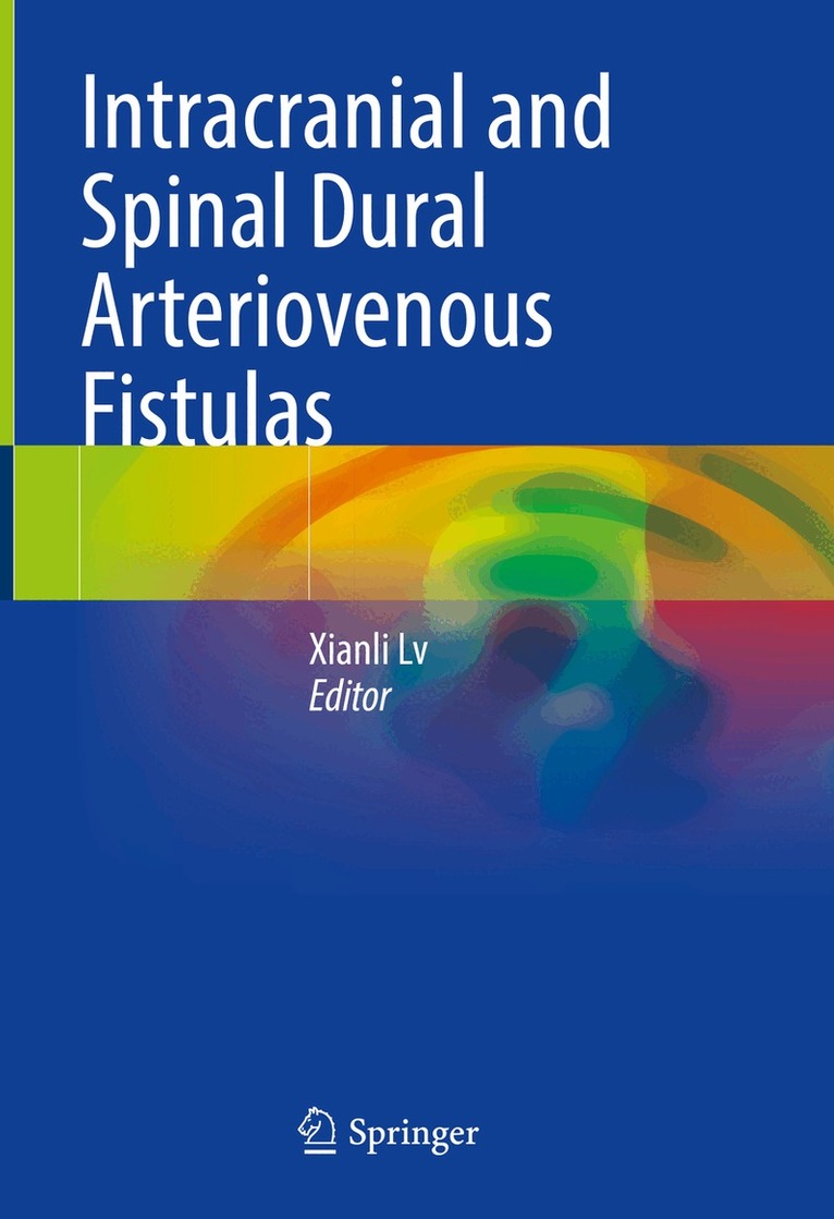 Xianli Lv - Intracranial and Spinal Dural Arteriovenous Fistulas, Inbunden