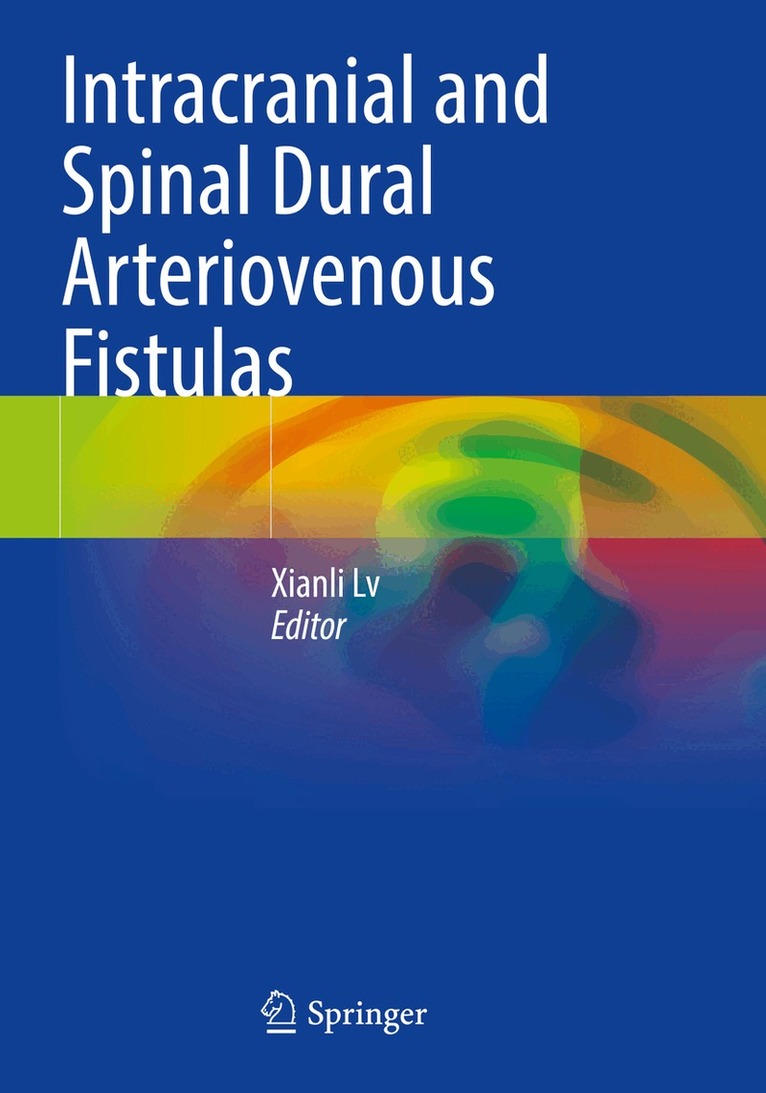 Xianli Lv - Intracranial and Spinal Dural Arteriovenous Fistulas, Häftad
