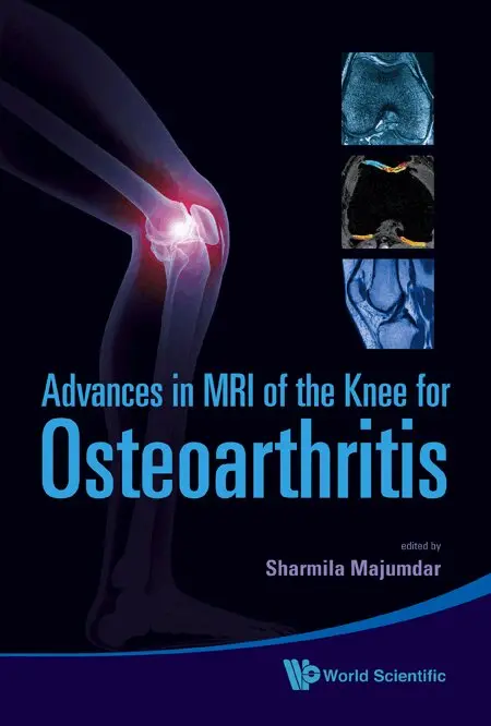 Majumdar Sharmila, Sharmila Majumdar - ADVANCES IN MRI OF THE KNEE FOR OSTEOARTHRITIS, Inbunden. Tillgänglighet: Lägg i varukorg