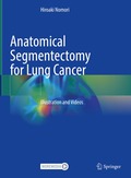 Anatomical Segmentectomy for Lung Cancer