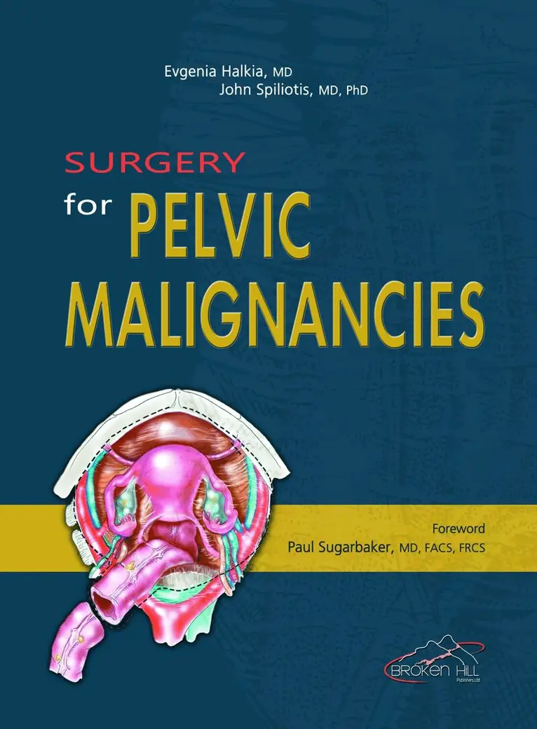 Evgenia Halkia, John Spiliotis - Surgery for Pelvic Malignancies, Inbunden. Tillgänglighet: Tillfälligt slut