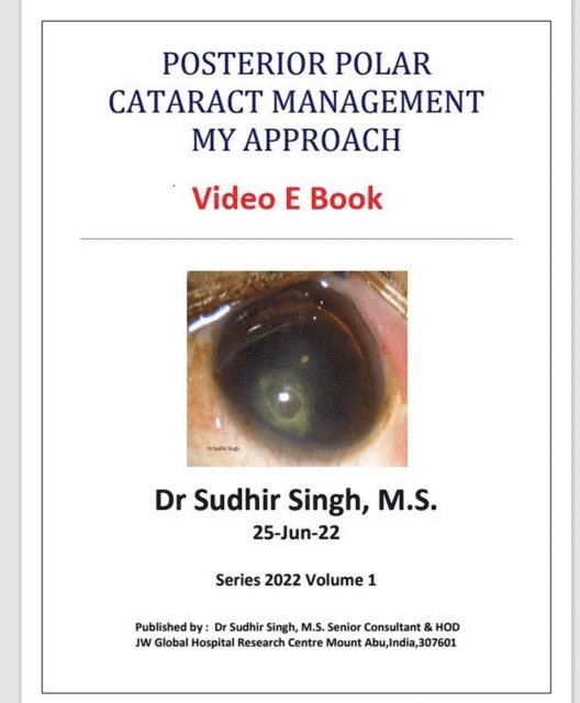 Sudhir Singh - Posterior Polar Cataract Management: My Approach, E-bok