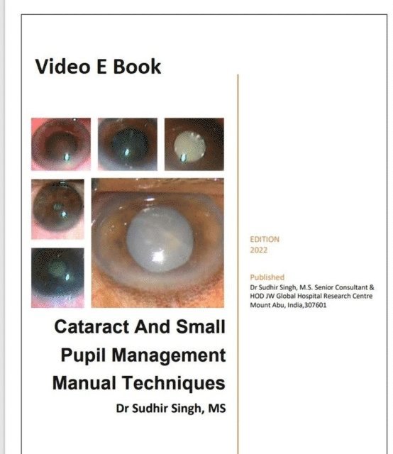 Sudhir Singh - Cataract And Small Pupil Management Manual Techniques, E-bok