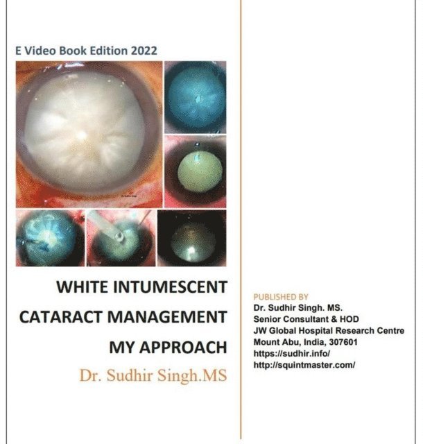 Sudhir Singh - White Intumescent Cataract Management: My Approach, E-bok