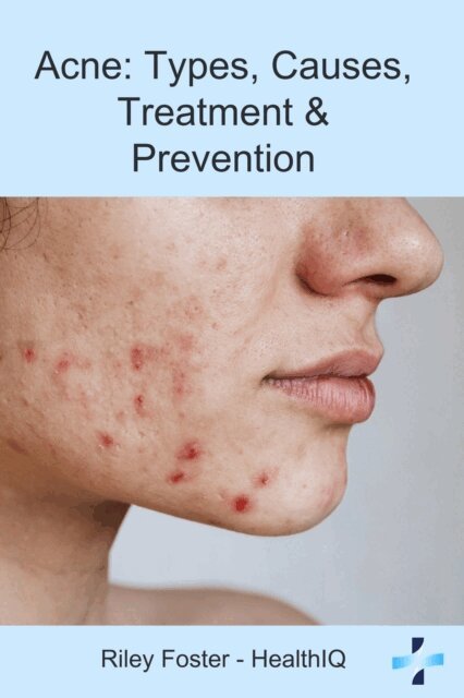 Riley Foster - Acne: Types, Causes, Treatment & Prevention, E-bok. Tillgänglighet: Lägg i varukorg