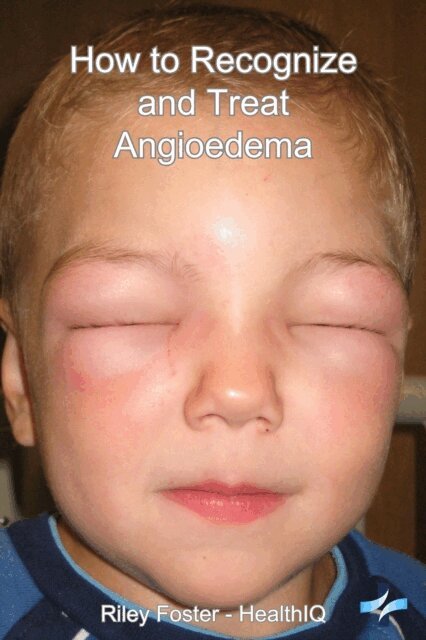 Riley Foster - How to Recognize and Treat Angioedema, E-bok. Tillgänglighet: Lägg i varukorg