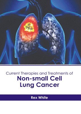 Rex White - Current Therapies and Treatments of Non-Small Cell Lung Cancer, Inbunden. Tillgänglighet: Lägg i varukorg